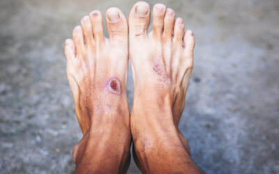 Why is Wound Care Important?