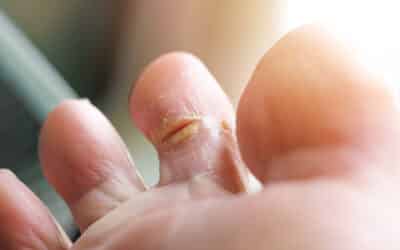 Why Won’t My Wound Heal? Understanding Why Some Wounds Don’t Heal