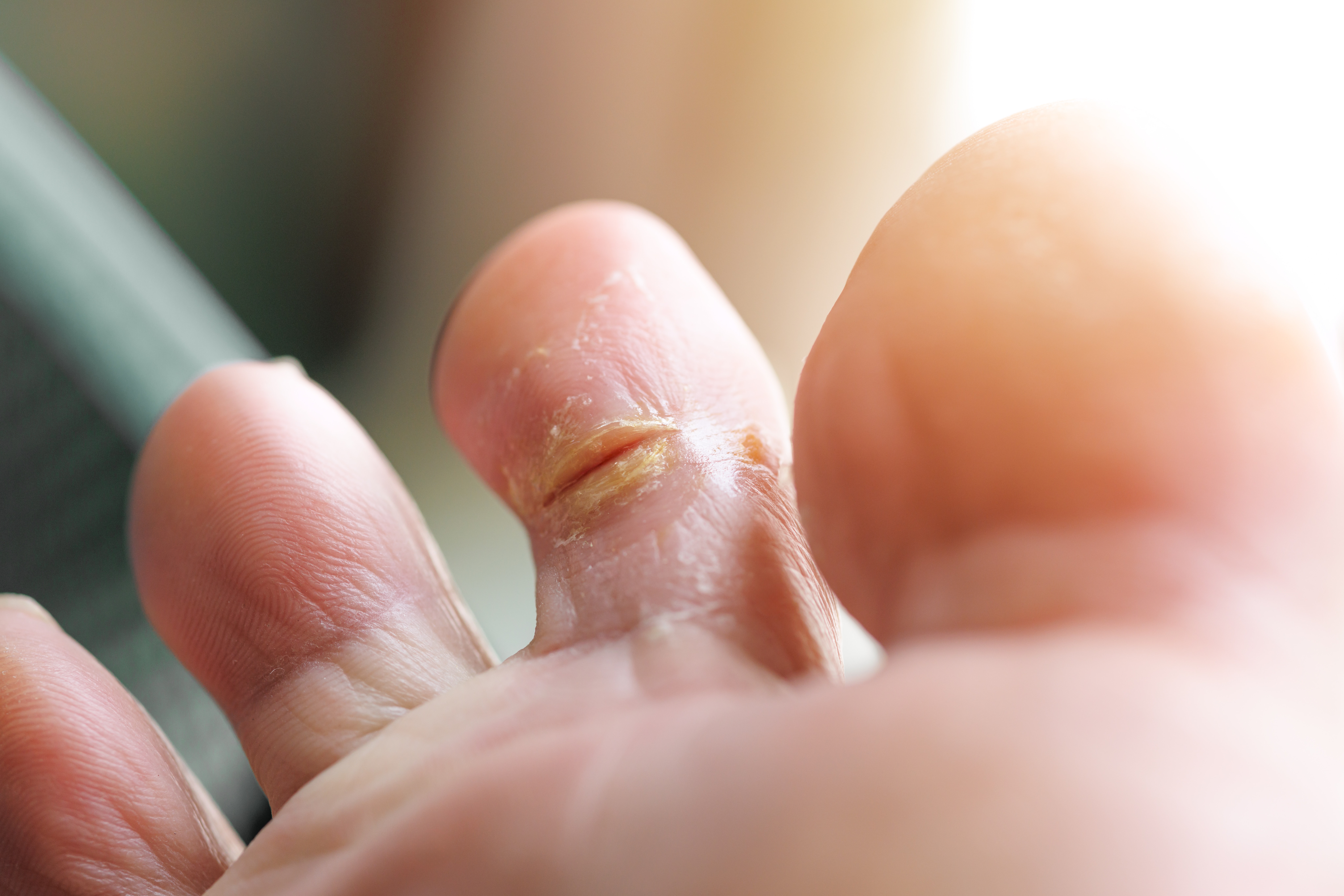 Dry, cracked toe wounds infection wet moist feet skin fungi, Athlete foot tinea pedis Dry, cracked toe wounds infection wet moist feet skin fungi, Athlete foot tinea pedis