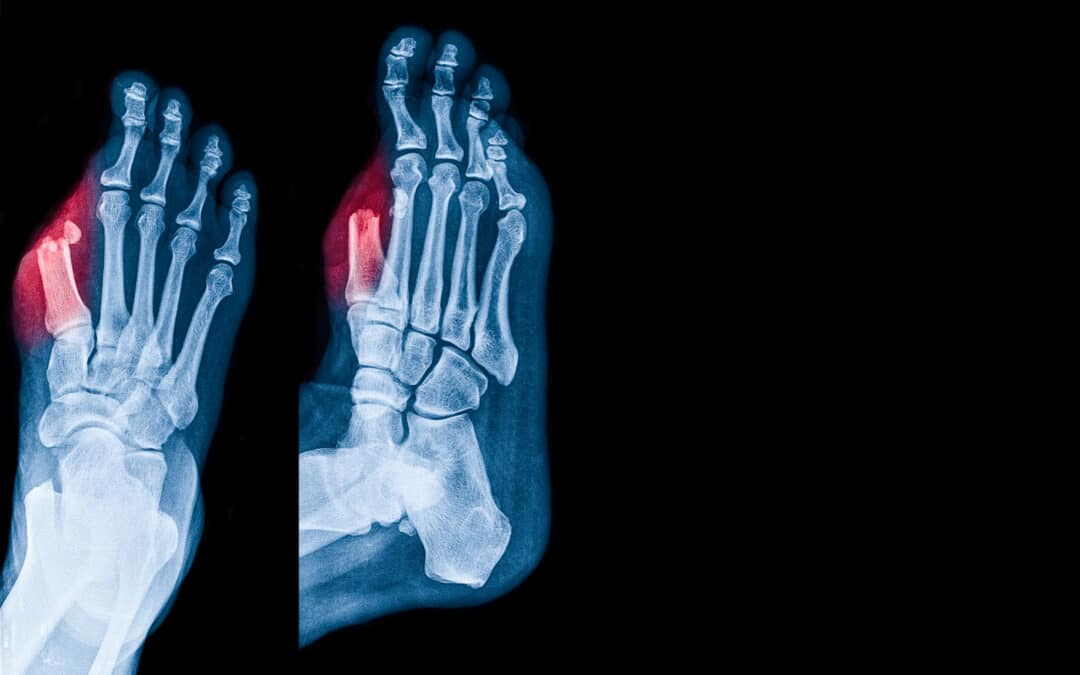 Why Diabetic Foot Ulcers Often Require X-Rays