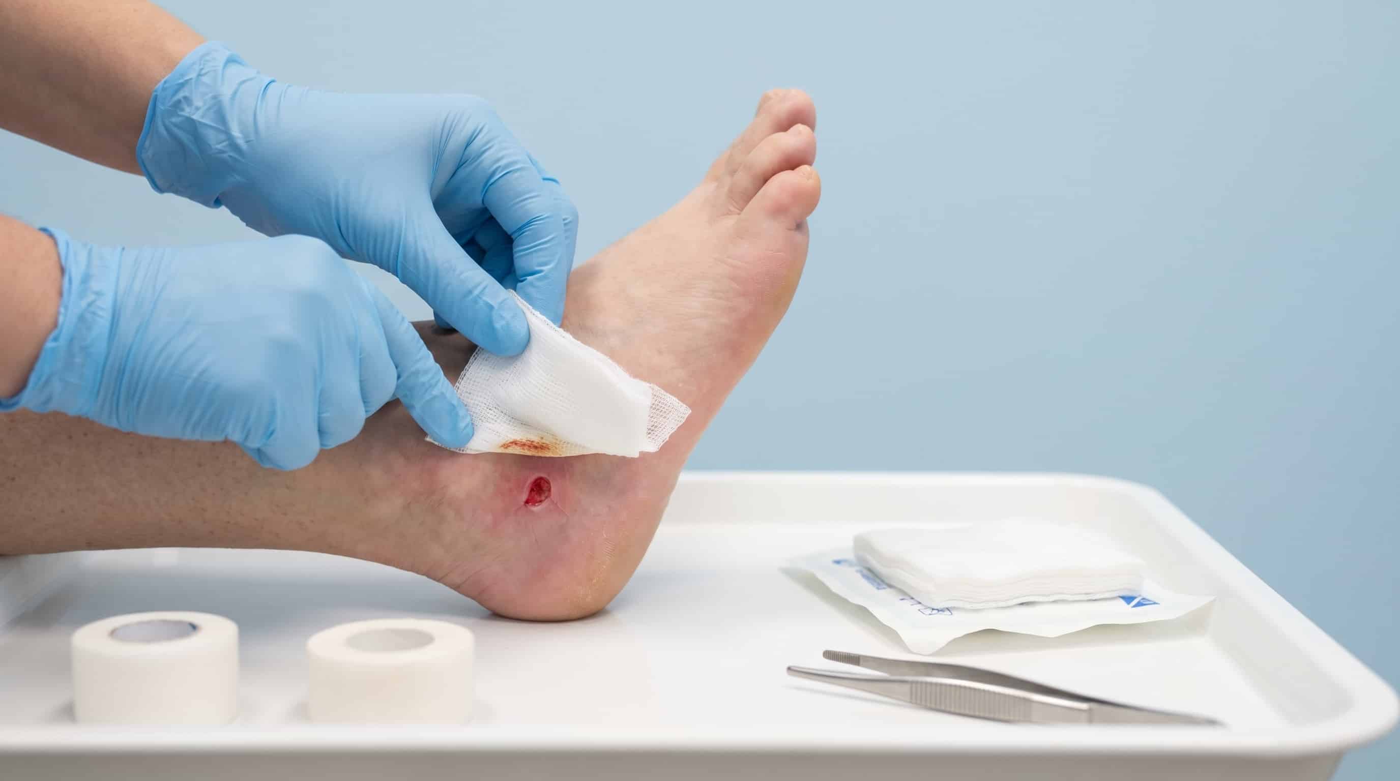Medical professional applying gauze dressing to a wound on patient foot heel in clinic Medical professional applying gauze dressing to a wound on patient foot heel in clinic
